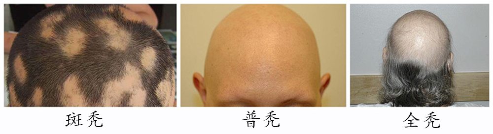 脱发分类